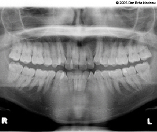 Marie-Hélène Cyr - Panoramic X-ray before the orthodontic treatments (November 24, 2005)